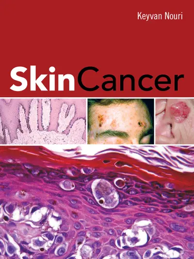 Skin Cancer Skin Cancer