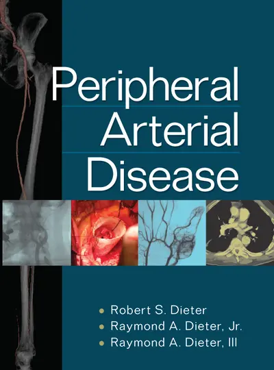 Peripheral Arterial Disease Peripheral Arterial Disease
