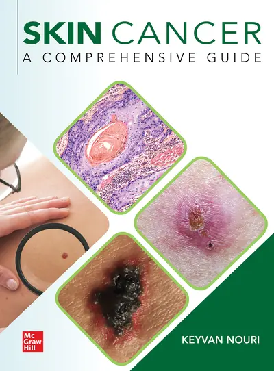 Skin Cancer: A Comprehensive Guide Skin Cancer: A Comprehensive Guide