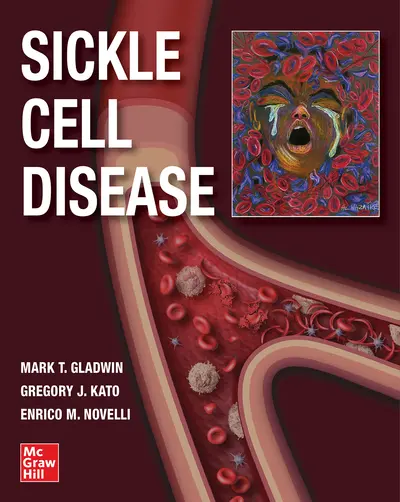 Sickle Cell Disease Sickle Cell Disease